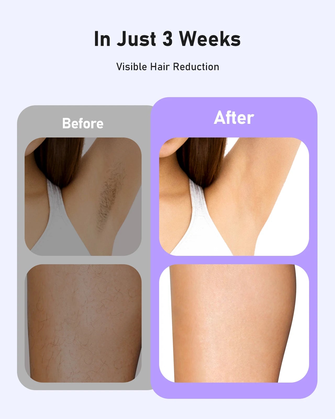 IPL Laser Hair Removal Device – 999,999 Flashes, 9 Levels